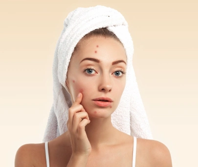 Acne Treatment