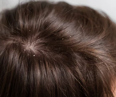 Dandruff & Scalp issues