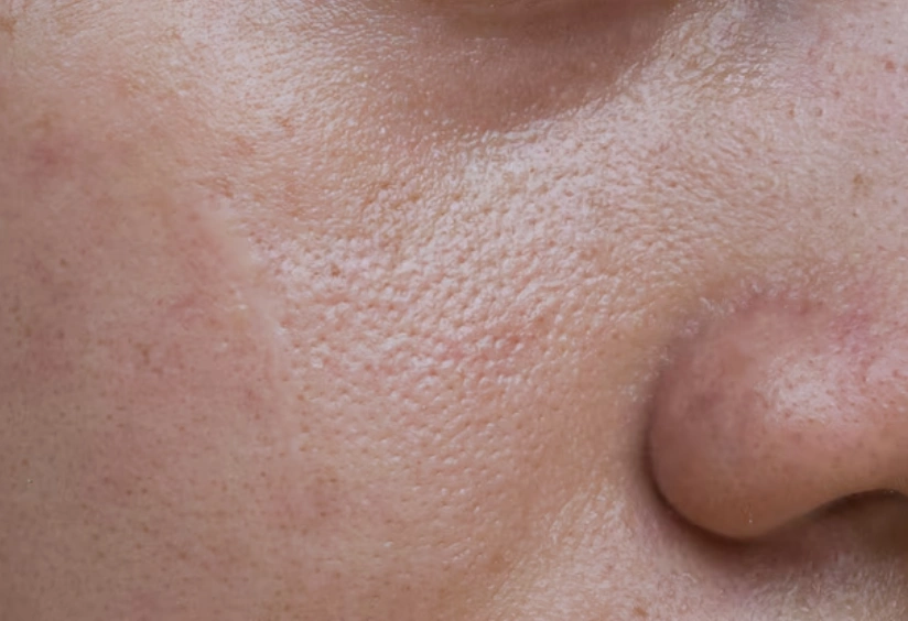 Unlock Pore-Free Skin: Easy Solutions to Reduce Facial Pores