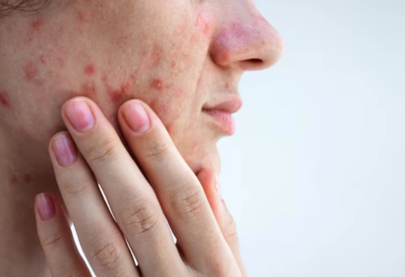 Hormonal Acne: Causes, Symptoms, Treatment & Prevention Tips