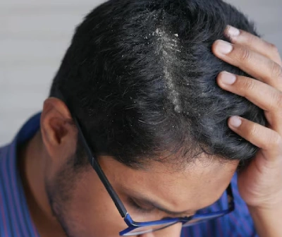 Dandruff Treatment in Delhi