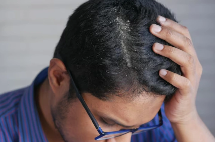 Dandruff Treatment in Delhi