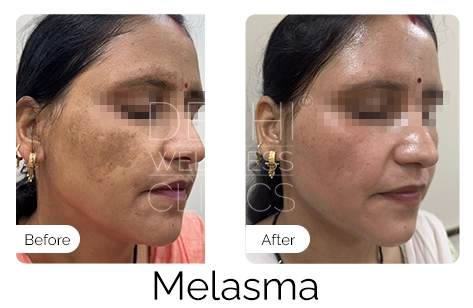 Melasma Before & After