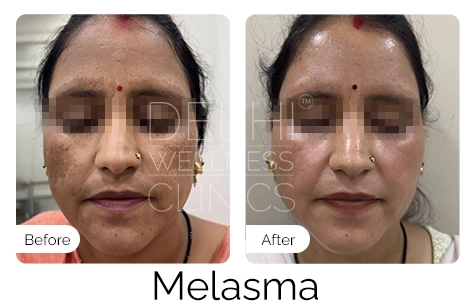 Melasma Before & After