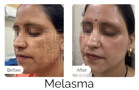 Melasma Before & After