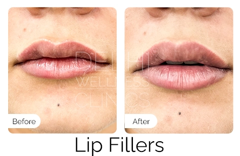 Lip Fillers Before & After