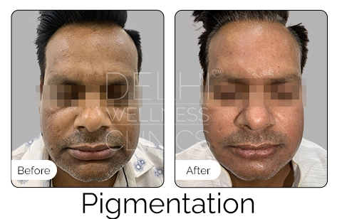 Pigmentation Before & After