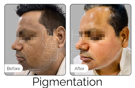 Pigmentation Before & After