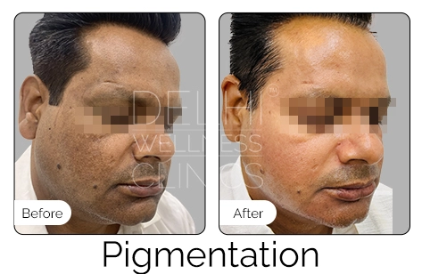 Pigmentation Before & After