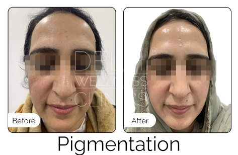 Pigmentation Before & After