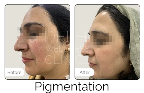 Pigmentation Before & After