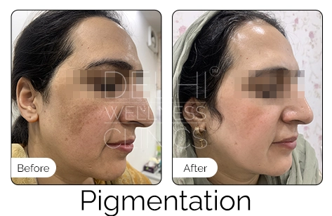 Pigmentation Before & After