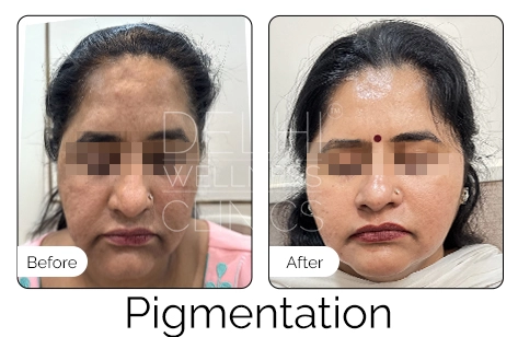 Pigmentation Before & After