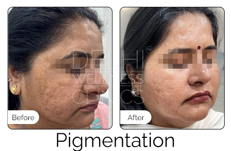 Pigmentation Before & After