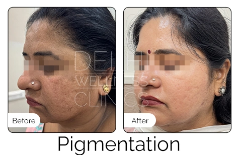 Pigmentation Before & After