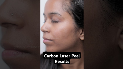 Carbon Laser Peel