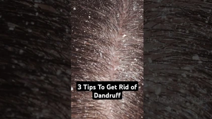 3 Tips to Get Rid of Dandruff This Winter