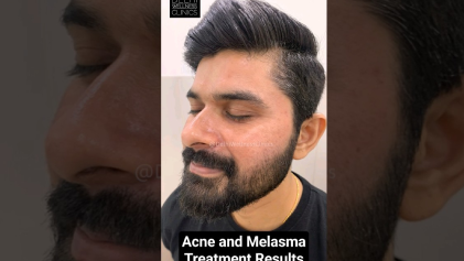 Acne and Melasma Treatment Results