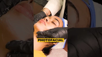 Get rid of Pigmentation, Sun Damage, Redness & Fine Lines with PHOTOFACIAL!