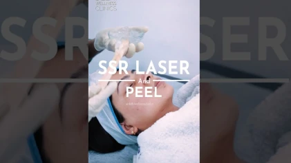 Skin Pulse Super Rejuvenation (SSR) Laser: Ultimate Skin Rejuvenation Anti Aging Treatment