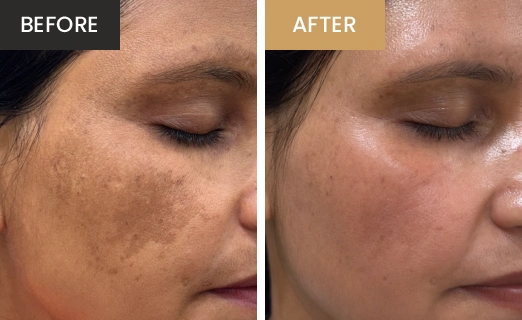 melasma Real Results
