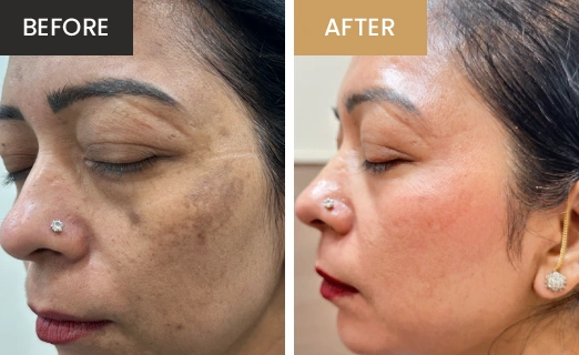 Laser Hair Removal Real Results