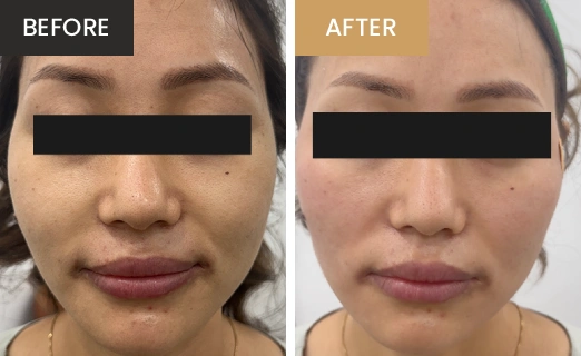 Laser Hair Removal Real Results