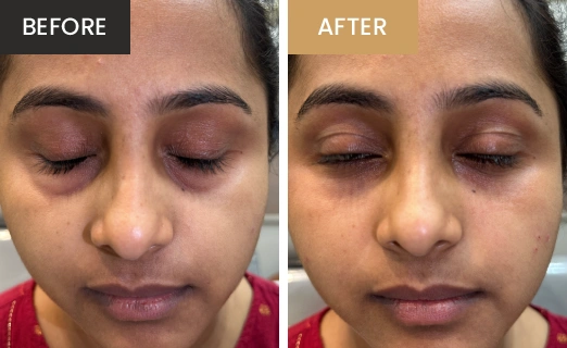 Laser Hair Removal Real Results