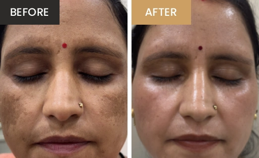 Laser Hair Removal Real Results