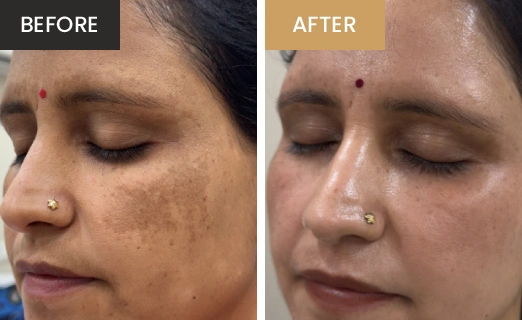 Laser Hair Removal Real Results