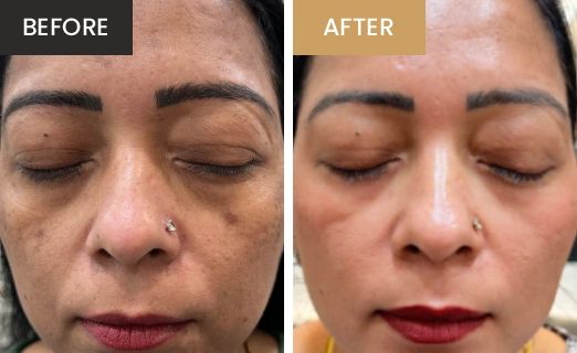 Laser Hair Removal Real Results