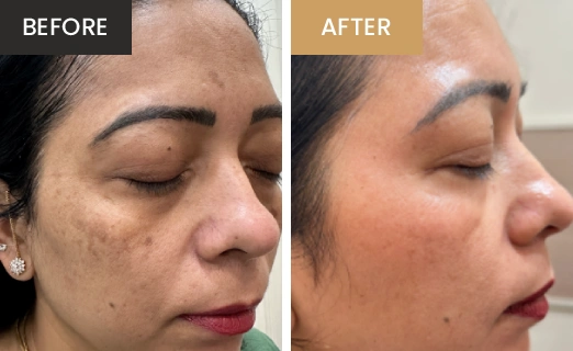 Laser Hair Removal Real Results