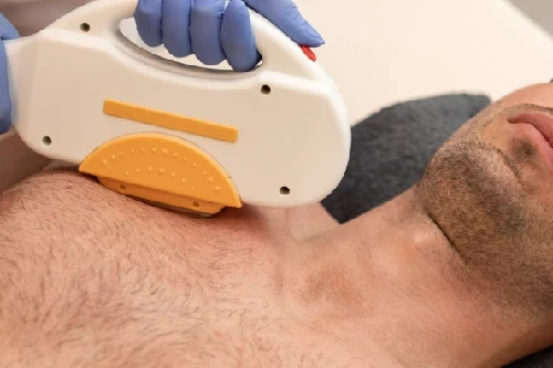Chest Laser Hair Removal