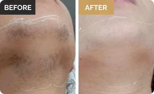 melasma Real Results