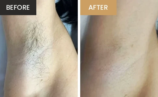Laser Hair Removal Real Results