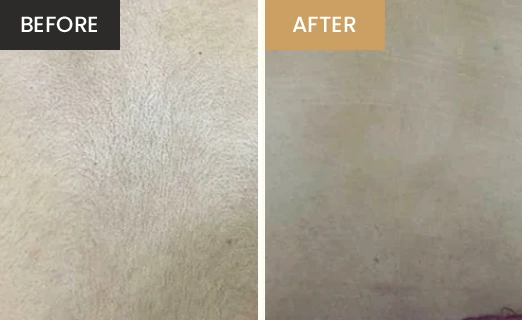 Laser Hair Removal Real Results