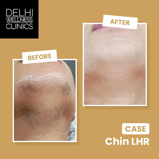 LHR Real Results